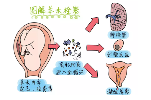 石门县人民医院【卓越医疗】产妇突发羊水栓塞，产科医护生死救援